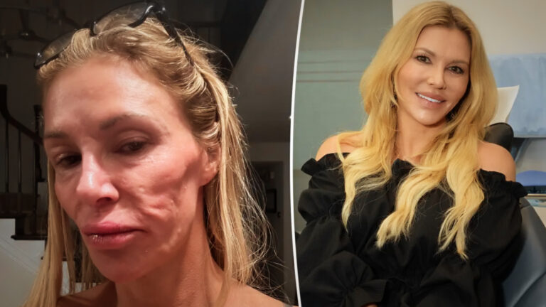 Brandi Glanville Battles ‘Deep Depression’ Amid Facial Disfigurement Struggles