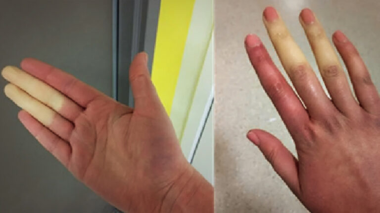 Common Disease Could Be Why Your Fingers Turn a Different Colour in Cold Winter Months