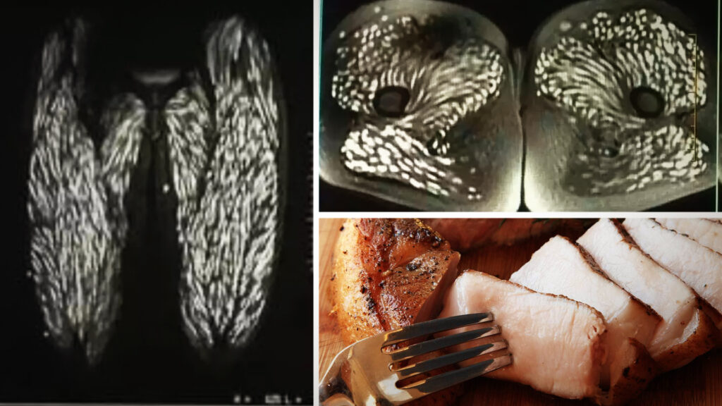 Horrifying scans show parasite infested eating raw pork 000