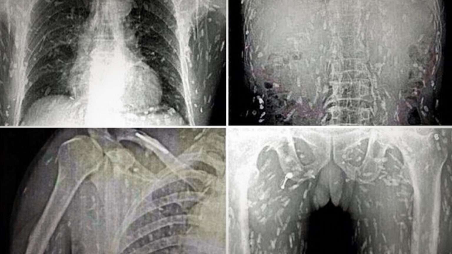 X RAY SHOWS body full of TAPEWORMS 000