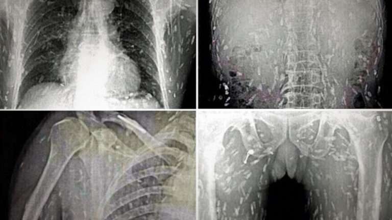 Disturbing X-ray Reveals a Body Infested With Tapeworms: The Shocking Consequences of a Kitchen Mistake