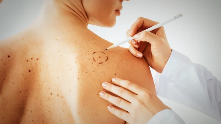 Experts Warn: Skin Marks That Could Signal Deadly Cancer – Early Signs You Should Never Ignore